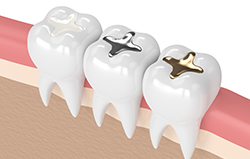 3D Model of Silver and Gold Fillings