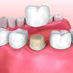 Dental Crown Step 1