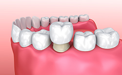 Dental Crown Step 2