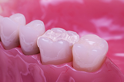 Dental Inlay Step 3