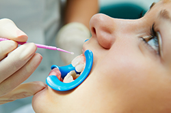 Child Having Dental Sealant Applied
