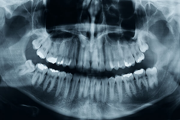 Dental X Ray